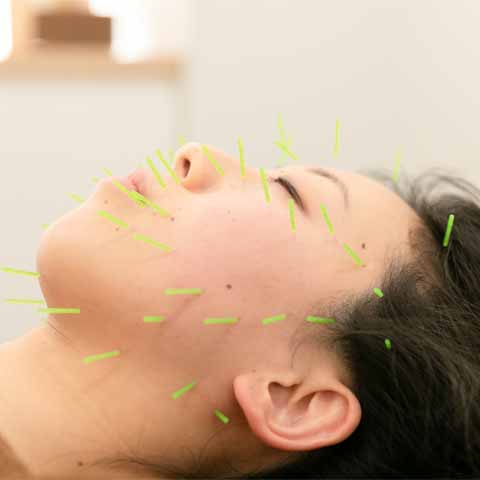 顔に鍼がたくさん刺さっている様子