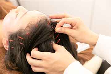 頭皮に鍼を打つ様子