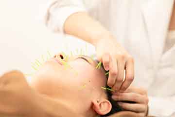 顔に鍼を打つ様子