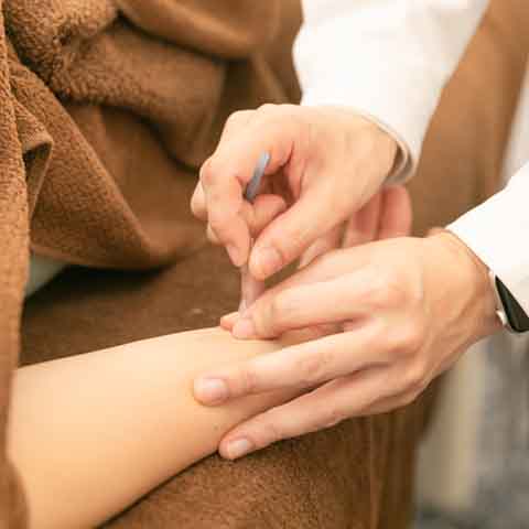 手首に鍼を打つ様子