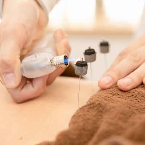 灸頭鍼に火を付ける様子